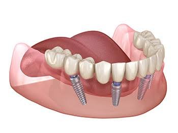 Understanding the Benefits of All-on-X Dental Implants